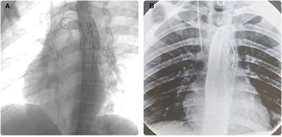 Case Report: Unique management strategy for rare case of esophageal foreign body